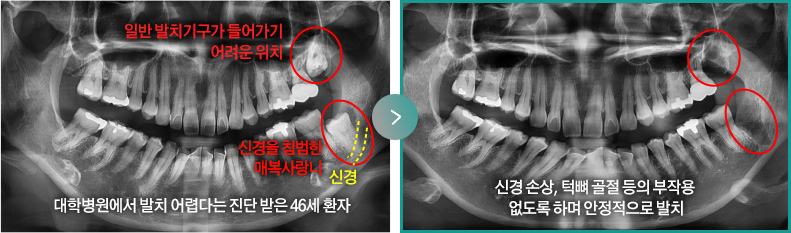 대학병원에서 발치 어렵다는 진단 받은 46세 환자(일반 발치기구가 들어가기 어려운 위치, 신경을 침범한 매복사랑니) > 신경 손상, 턱뼈 골절 등의 부작용 없도록 하며 안정적으로 발치