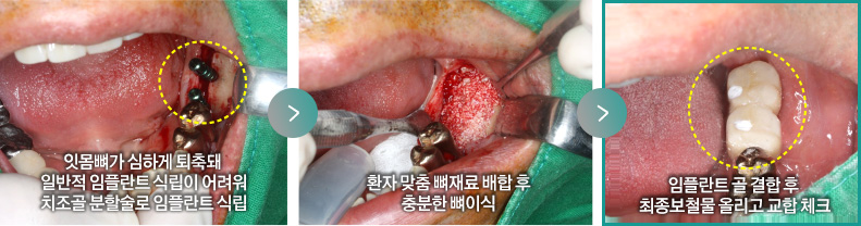 잇몸뼈가 심하게 퇴축돼 일반적 임플란트 식립이 어려워 치조골 분할술로 임플란트 식립 > 환자 맞춤 뼈재료 배합 후 충분한 뼈이식 > 임플란트 골 결합 후  최종보철물 올리고 교합 체크