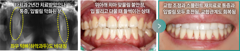 타치과 2년간 치료받았으나 통증, 입벌림 악화된 분(좌우 턱뼈(하악과두)도 비대칭), 위아래 치아 맞물림 불안정, 입 벌리고 다물 때 들썩이는 상태 > 교합 조정과 스플린트 재치료로 통증과 입벌림 모두 호전됨. 교합관계도 회복됨