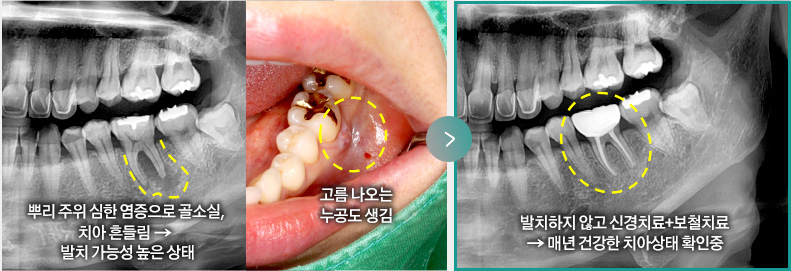 뿌리 주위 심한 염증으로 골소실, 치아 흔들림 →  발치 가능성 높은 상태, 고름 나오는 누공도 생김 > 발치하지 않고 신경치료+보철치료 → 매년 건강한 치아상태 확인중