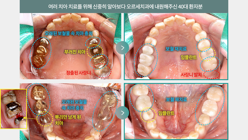 여러 치아 치료를 위해 신중히 알아보다 오르세치과에 내원해주신 40대 환자분