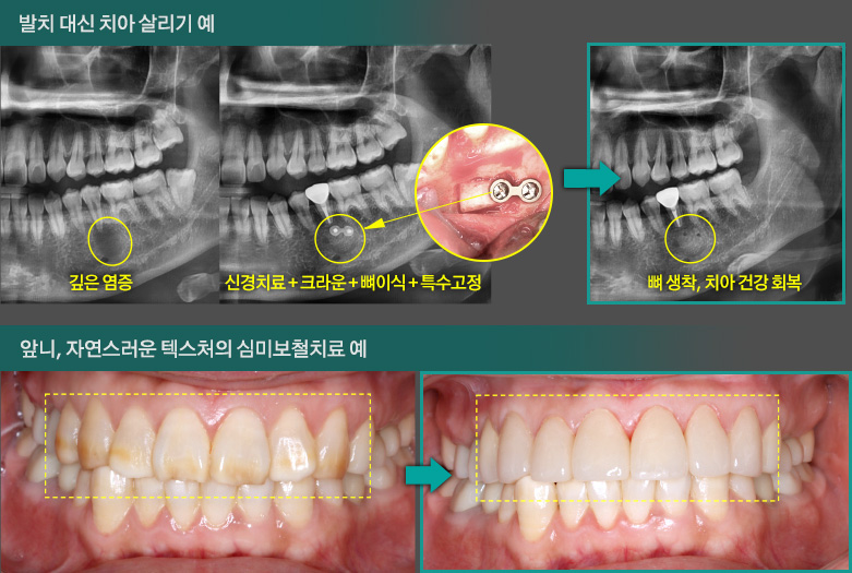 발치 대신 치아 살리기 예, 앞니, 자연스러운 텍스처의 심미보철치료 예