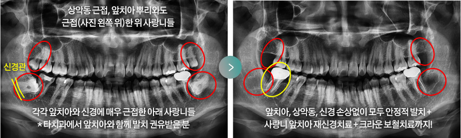 상악동 근접, 앞치아 뿌리와도 근접(사진 왼쪽 위)한 위 사랑니들 / 각각 앞치아와 신경에 매우 근접한 아래 사랑니들 * 타치과에서 앞치아와 함께 발치 권유받은 분 > 앞치아, 상악동, 신경 손상없이 모두 안정적 발치 + 사랑니 앞치아 재신경치료 + 크라운 보철치료까지!