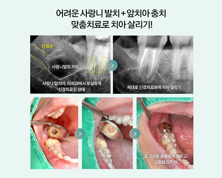 어려운 사랑니 발치 + 앞치아 충치 맞춤치료로 치아 살리기! 사랑니 앞치아, 타치과에서 부실하게 신경치료된 상태 > 제대로 신경치료하여 치아 살리기 > 금 크라운 꼼꼼하게 씌우고 교합체크까지!
