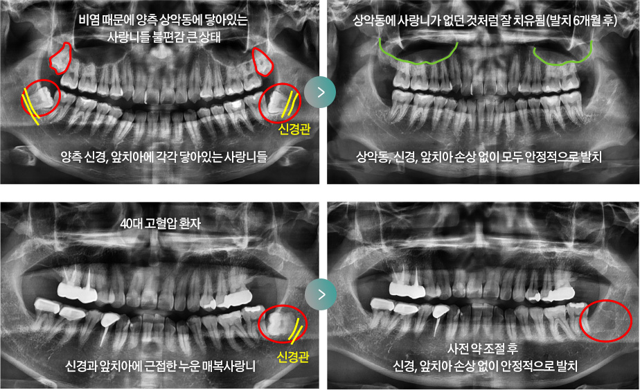 비염 때문에 양측 상악동에 닿아있는 사랑니들 불편감 큰 상태 - 양측 신경, 앞치아에 각각 닿아있는 사랑니들 > 상악동에 사랑니가 없던 것처럼 잘 치유됨(발치 6개월 후) - 상악동, 신경, 앞치아 손상 없이 모두 안정적으로 발치 / 40대 고혈압 환자 신경과 앞치아에 근접한 누운 매복사랑니 > 사전 약 조절 후 신경, 앞치아 손상 없이 안정적으로 발치