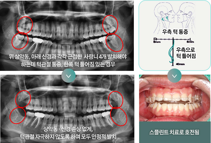 위 상악동, 아래 신경과 각각 근접한 사랑니 4개 발치해야 하는데 턱관절 통증, 한쪽 턱 틀어짐 있는 경우 > 상악동 · 신경 손상 없게, 턱관절 자극하지 않도록 하며 모두 안정적 발치 / 우측 턱 통증, 우측으로 턱 틀어짐 > 스플린트 치료로 호전됨