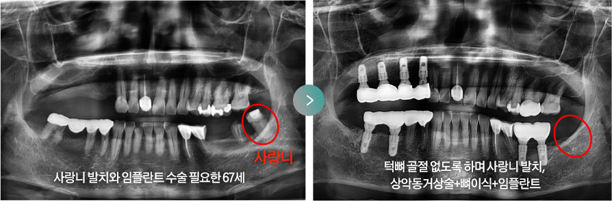 사랑니 발치와 임플란트 수술 필요한 67세 > 턱뼈 골절 없도록 하며 사랑니 발치, 상악동거상술+뼈이식+임플란트