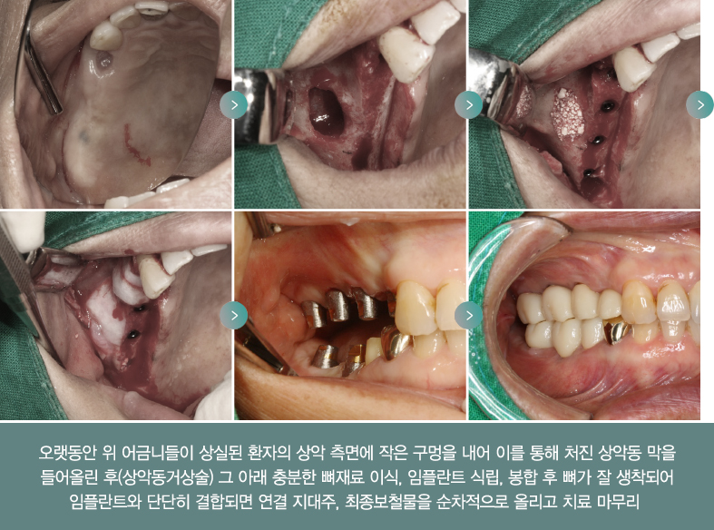 오랫동안 위 어금니들이 상실된 환자의 상악 측면에 작은 구멍을 내어 이를 통해 처진 상악동 막을 들어올린후(상악동거상술) 그 아래 충분한 뼈재료 이식, 임플란트 식립, 봉합 후 뼈가 잘 생착되어 임플란트와 단단히 결합되면 연결 지대주, 최종보철물을 순차적으로 올리고 치료 마무리