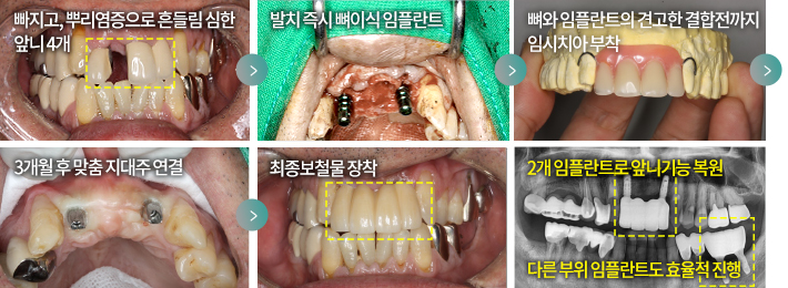 빠지고, 뿌리염증으로 흔들림 심한 앞니 4개 > 발치 즉시 뼈이식 임플란트 > 뼈와 임플란트의 견고한 결합전까지 임시치아 부착 > 3개월 후 맞춤 지대주 연결 > 최종보철물 장착 > 2개 임플란트로 앞니 기능 복원, 다른 부위 임플란트도 효율적 진행