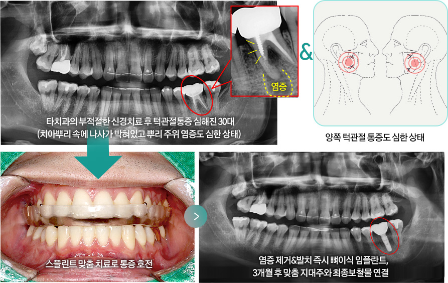 타치과의 부적절한 신경치료 후 턱관절통증 심해진 30대(치아뿌리 속에 나사가 박혀있고 뿌리 주위 염증도 심한 상태) & 양쪽 턱관절 통증도 심한 상태 > 스플린트 맞춤 치료로 통증 호전 > 염증 제거&발치 즉시 뼈이식 임플란트, 3개월 후 맞춤 지대주와 최종보철물 연결