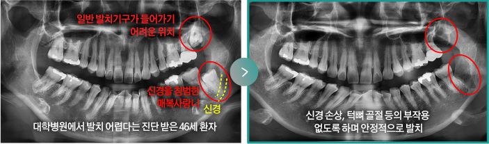 대학병원에서 발치 어렵다는 진단 받은 46세 환자(일반 발치기구가 들어가기 어려운 위치, 신경을 침범한 매복사랑니) > 신경 손상, 턱뼈 골절 등의 부작용 없도록 하며 안정적으로 발치