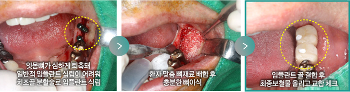 잇몸뼈가 심하게 퇴축돼 일반적 임플란트 식립이 어려워 치조골 분할술로 임플란트 식립 > 환자 맞춤 뼈재료 배합 후 충분한 뼈이식 > 임플란트 골 결합 후  최종보철물 올리고 교합 체크