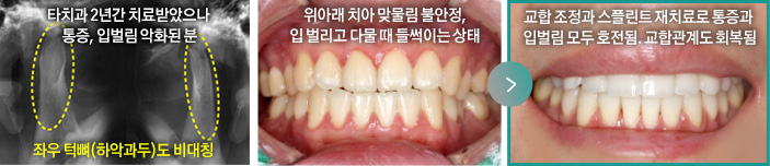 타치과 2년간 치료받았으나 통증, 입벌림 악화된 분(좌우 턱뼈(하악과두)도 비대칭), 위아래 치아 맞물림 불안정, 입 벌리고 다물 때 들썩이는 상태 > 교합 조정과 스플린트 재치료로 통증과 입벌림 모두 호전됨. 교합관계도 회복됨