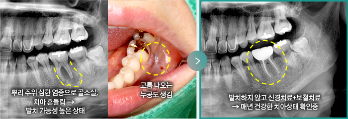 뿌리 주위 심한 염증으로 골소실, 치아 흔들림 →  발치 가능성 높은 상태, 고름 나오는 누공도 생김 > 발치하지 않고 신경치료+보철치료 → 매년 건강한 치아상태 확인중