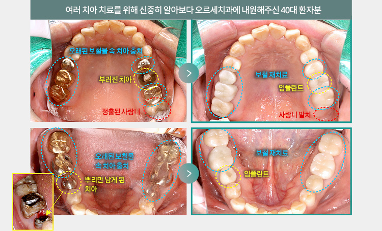 여러 치아 치료를 위해 신중히 알아보다 오르세치과에 내원해주신 40대 환자분