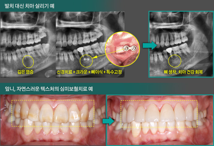 발치 대신 치아 살리기 예, 앞니, 자연스러운 텍스처의 심미보철치료 예