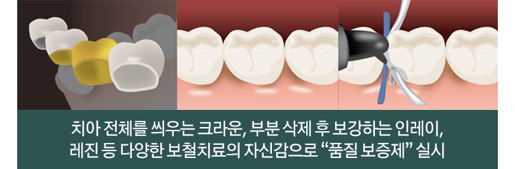치아 전체를 씌우는 크라운, 부분 삭제 후 보강하는 인레이, 레진 등 다양한 보철치료의 자신감으로 “품질 보증제” 실시