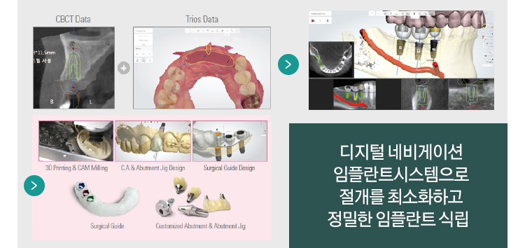 디지털 네비게이션 임플란트시스템으로 절개를 최소화하고 정밀한 임플란트 식립