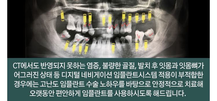 CT에서도 반영되지 못하는 염증, 불량한 골질, 발치 후 잇몸과 잇몸뼈가 어그러진 상태 등 디지털 네비게이션 임플란트시스템 적용이 부적합한 경우에는 고난도 임플란트 수술 노하우를 바탕으로 안정적으로 치료해 오랫동안 편안하게 임플란트를 사용하시도록 해드립니다.