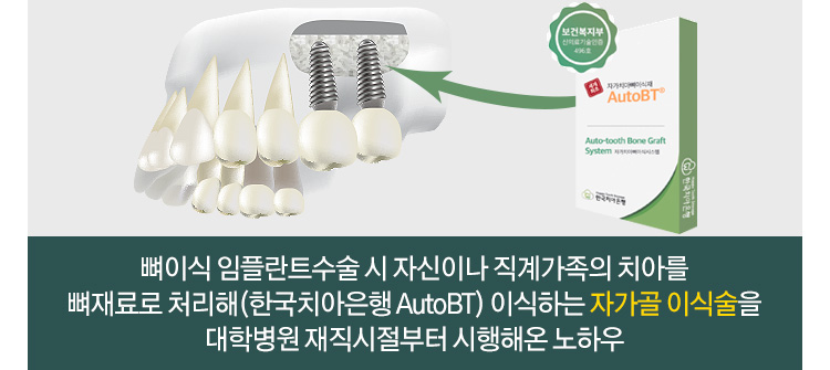 뼈이식 임플란트수술 시 자신이나 직계가족의 치아를 뼈재료로 처리해(한국치아은행 AutoBT) 이식하는 자가골 이식술을 대학병원 재직시절부터 시행해온 노하우