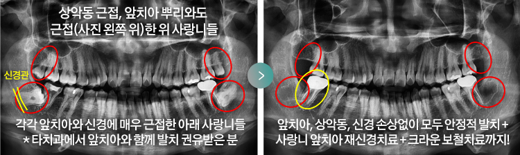 상악동 근접, 앞치아 뿌리와도 근접(사진 왼쪽 위)한 위 사랑니들 / 각각 앞치아와 신경에 매우 근접한 아래 사랑니들 * 타치과에서 앞치아와 함께 발치 권유받은 분 > 앞치아, 상악동, 신경 손상없이 모두 안정적 발치 + 사랑니 앞치아 재신경치료 + 크라운 보철치료까지!