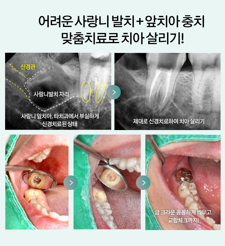 어려운 사랑니 발치 + 앞치아 충치 맞춤치료로 치아 살리기! 사랑니 앞치아, 타치과에서 부실하게 신경치료된 상태 > 제대로 신경치료하여 치아 살리기 > 금 크라운 꼼꼼하게 씌우고 교합체크까지!