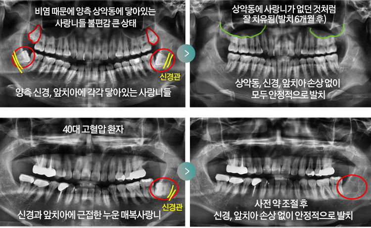 비염 때문에 양측 상악동에 닿아있는 사랑니들 불편감 큰 상태 - 양측 신경, 앞치아에 각각 닿아있는 사랑니들 > 상악동에 사랑니가 없던 것처럼 잘 치유됨(발치 6개월 후) - 상악동, 신경, 앞치아 손상 없이 모두 안정적으로 발치 / 40대 고혈압 환자 신경과 앞치아에 근접한 누운 매복사랑니 > 사전 약 조절 후 신경, 앞치아 손상 없이 안정적으로 발치