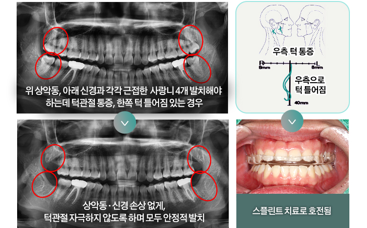 위 상악동, 아래 신경과 각각 근접한  사랑니 4개 발치해야 하는데 턱관절 통증, 한쪽 턱 틀어짐 있는 경우 > 상악동 · 신경 손상 없게, 턱관절 자극하지 않도록 하며 모두 안정적 발치 / 우측 턱 통증, 우측으로 턱 틀어짐 > 스플린트 치료로 호전됨