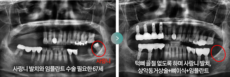 사랑니 발치와 임플란트 수술 필요한 67세 > 턱뼈 골절 없도록 하며 사랑니 발치, 상악동거상술+뼈이식+임플란트