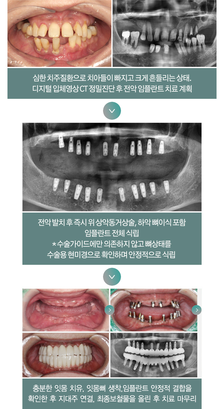 심한 치주질환으로 치아들이 빠지고 크게 흔들리는 상태. 디지털 입체영상 CT 정밀진단 후 전악 임플란트 치료 계획 > 전악 발치 후 즉시 위 상악동거상술, 하악 뼈이식 포함 임플란트 전체 식립(*수술가이드에만 의존하지 않고 뼈상태를 수술용 현미경으로 확인하며 안정적으로 식립) > 충분한 잇몸 치유, 잇몸뼈 생착, 임플란트 안정적 결합을 확인한 후 지대주 연결, 쵲오보철물을 올린 후 치료 마무리