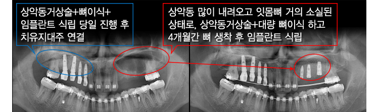 상악동거상술+뼈이식+임플란트 식립 당일 진행 후 치유지대주 연결 / 상악동 많이 내려오고 잇몸뼈 거의 소실된 상태로, 상악동거상술+대량 뼈이식 하고 4개월간 뼈 생착 후 임플란트 식립