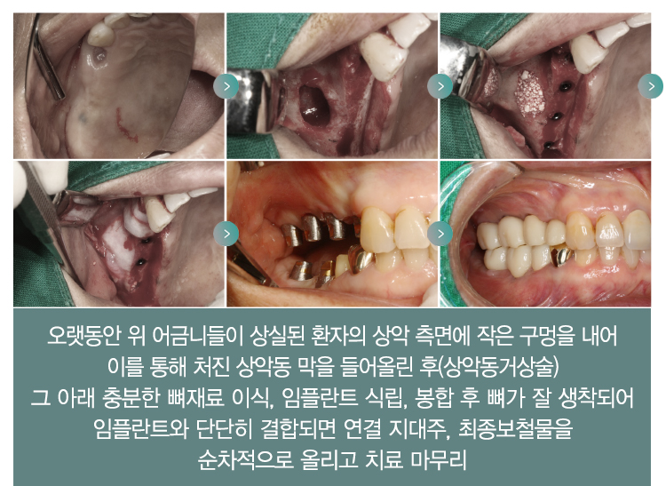오랫동안 위 어금니들이 상실된 환자의 상악 측면에 작은 구멍을 내어 이를 통해 처진 상악동 막을 들어올린후(상악동거상술) 그 아래 충분한 뼈재료 이식, 임플란트 식립, 봉합 후 뼈가 잘 생착되어 임플란트와 단단히 결합되면 연결 지대주, 최종보철물을 순차적으로 올리고 치료 마무리