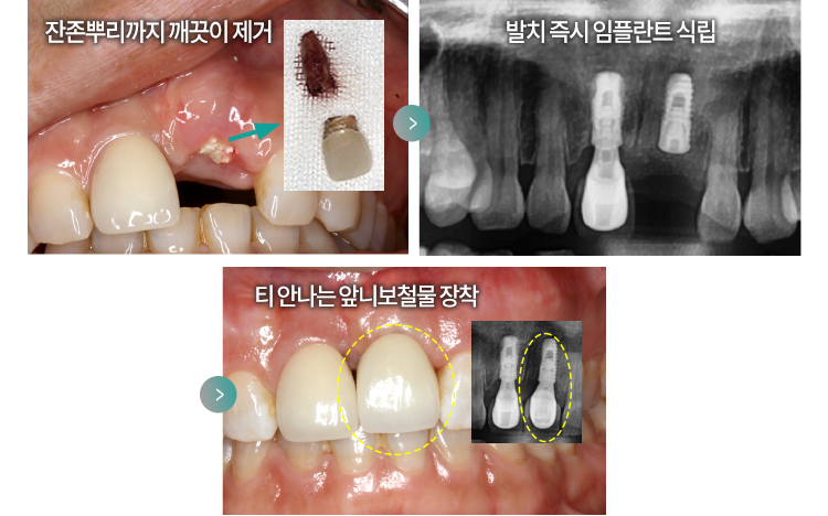잔존 뿌리까지 깨끗이 제거 > 발치 즉시 임플란트 식립 > 티 안나는 앞니 보철물 장착