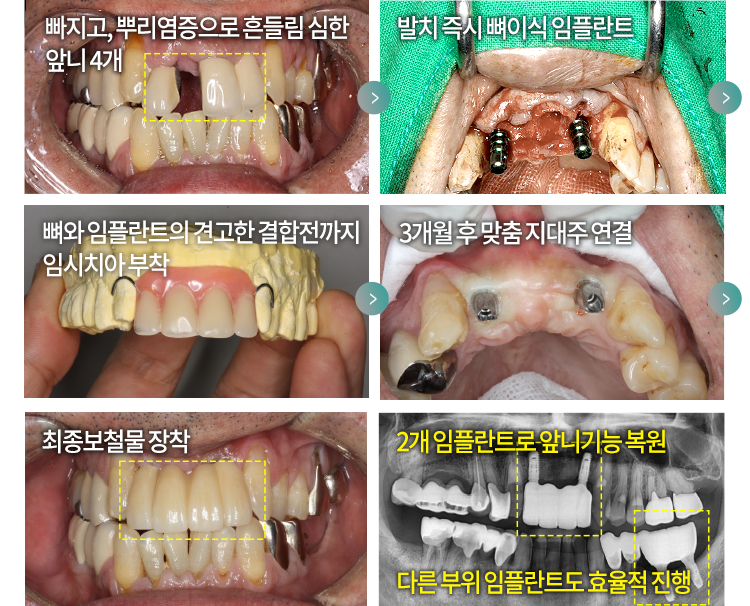 빠지고, 뿌리염증으로 흔들림 심한 앞니 4개 > 발치 즉시 뼈이식 임플란트 > 뼈와 임플란트의 견고한 결합전까지 임시치아 부착 > 3개월 후 맞춤 지대주 연결 > 최종보철물 장착 > 2개 임플란트로 앞니 기능 복원, 다른 부위 임플란트도 효율적 진행