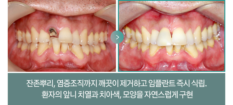 잔존뿌리, 염증조직까지 깨끗이 제거하고 임플란트 즉시 식립. 환자의 앞니 치열과 치아색, 모양을 자연스럽게 구현