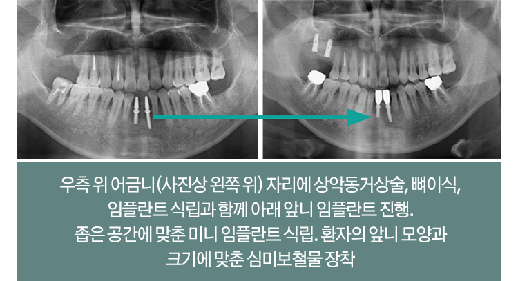 우측 위 어금니(사진상 왼쪽 위) 자리에 상악동거상술, 뼈이식, 임플란트 식립과 함께 아래 앞니 임플란트 진행. 좁은 공간에 맞춘 미니 임플란트 식립. 환자의 앞니 모양과 크기에 맞춘 심미보철물 장착