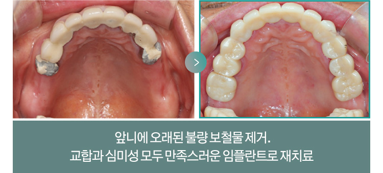 앞니에 오래된 불량 보철물 제거. 교합과 심미성 모두 만족스러운 임플란트로 재치료 