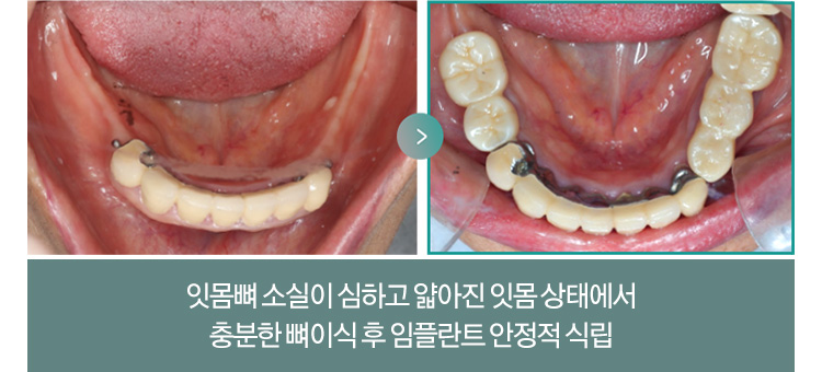 잇몸뼈 소실이 심하고 얇아진 잇몸 상태에서 충분한 뼈이식 후 임플란트 안정적 식립