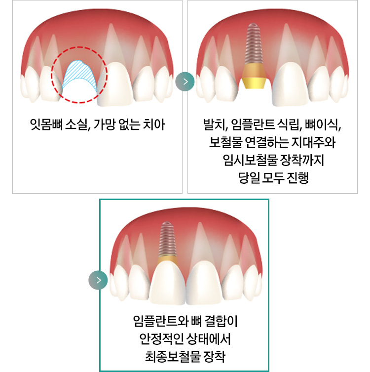 잇몸뼈 소실, 가망 없는 치아 > 발치, 임플란트 식립, 뼈이식, 보철물 연결하는 지대주와 임시보철물 장착까지 당일 모두 진행 > 임플란트와 뼈 결합이 안정적인 상태에서 최종보철물 장착