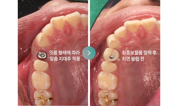 잇몸 형태에 따라 맞춤 지대주 적용 > 최종보철물 장착 후 치면 봉합 전