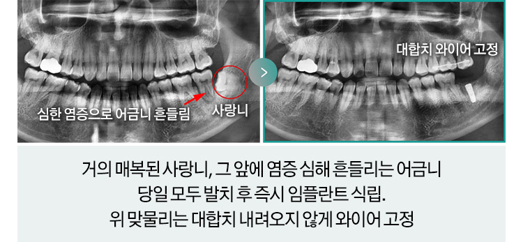 우측 위 작은 어금니(사진상 왼쪽 위)가 타치과 신경치료 후 뿌리에 심한 염증이 생겨 발치 후즉시 뼈이식과 임플란트 식립 진행