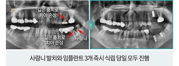 각각 상실된 아래 어금니 자리에 당일 즉시 임플란트 식립
