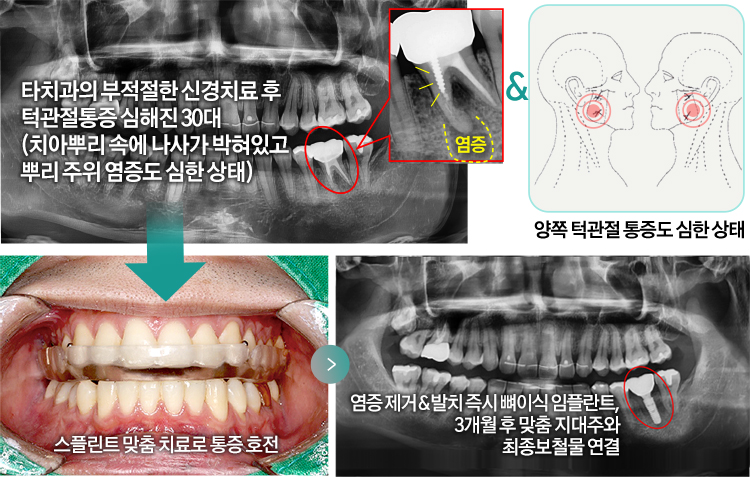 타치과의 부적절한 신경치료 후 턱관절통증 심해진 30대(치아뿌리 속에 나사가 박혀있고 뿌리 주위 염증도 심한 상태) &  양쪽 턱관절 통증도 심한 상태 > 스플린트 맞춤 치료로 통증 호전 > 염증 제거&발치 즉시 뼈이식 임플란트, 3개월 후 맞춤 지대주와 최종보철물 연결