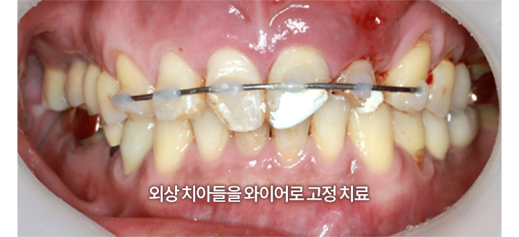 외상 치아들을 와이어로 고정 치료