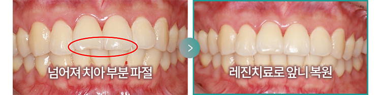 넘어져 치아 부분 파절 > 레진치료로 앞니 복원