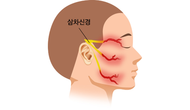 삼차신경