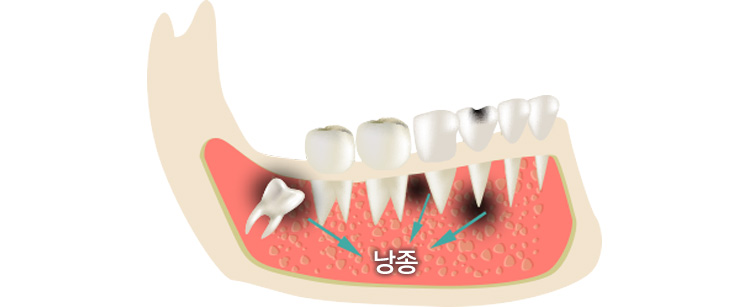 낭종