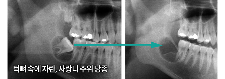 턱뼈 속에 자란, 사랑니 주위 낭종