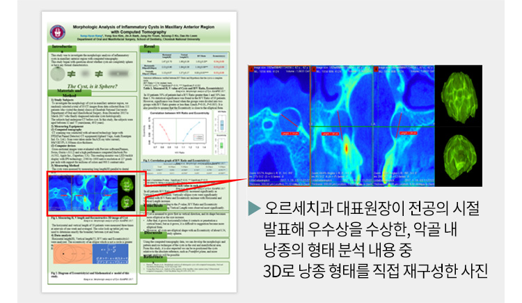 오르세치과 대표원장이 전공의 시절 발표해 우수상을 수상한, 악골 내 낭종의 형태 분석 내용 중 3D로 낭종 형태를 직접 재구성한 사진