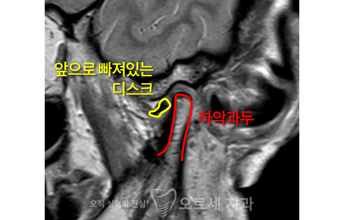 앞으로 빠져있는 디스크, 하악과두 이미지